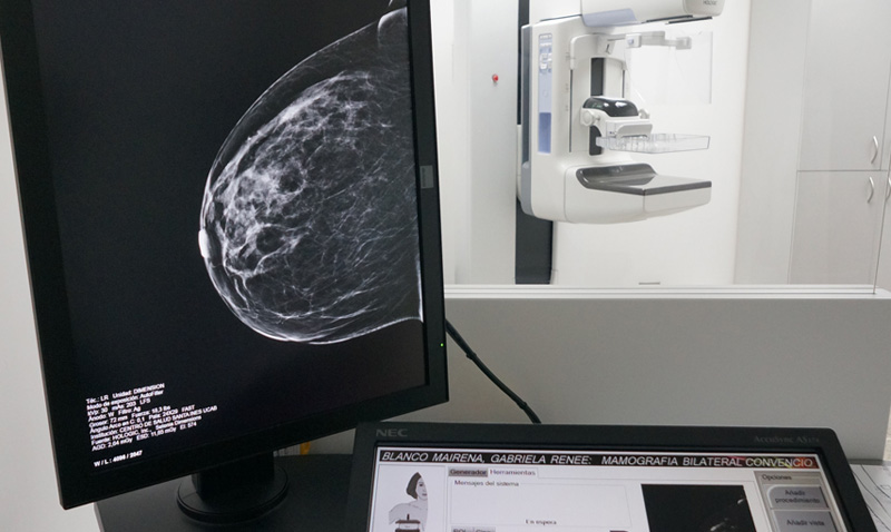La tomosíntesis detecta precozmente el cáncer de mama